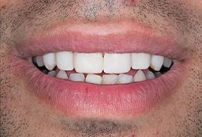Michael Korngold, DDS | Dentures, Teeth Whitening and Crowns  amp  Caps