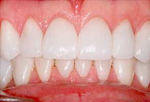 Michael Korngold, DDS | Dental Bridges, Oral Exams and Invisalign reg 