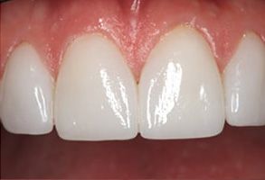 Michael Korngold, DDS | Crowns  amp  Caps, Dentures and Veneers