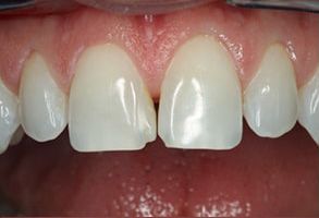 Michael Korngold, DDS | Preventive Program, Crowns  amp  Caps and Oral Exams