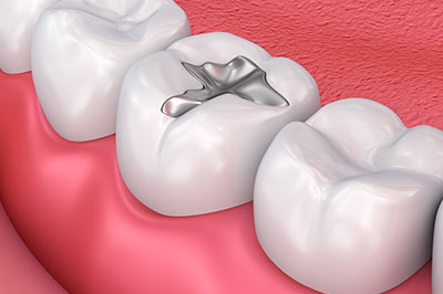 Michael Korngold, DDS | Periodontal Treatment, Dental Bridges and Crowns  amp  Caps